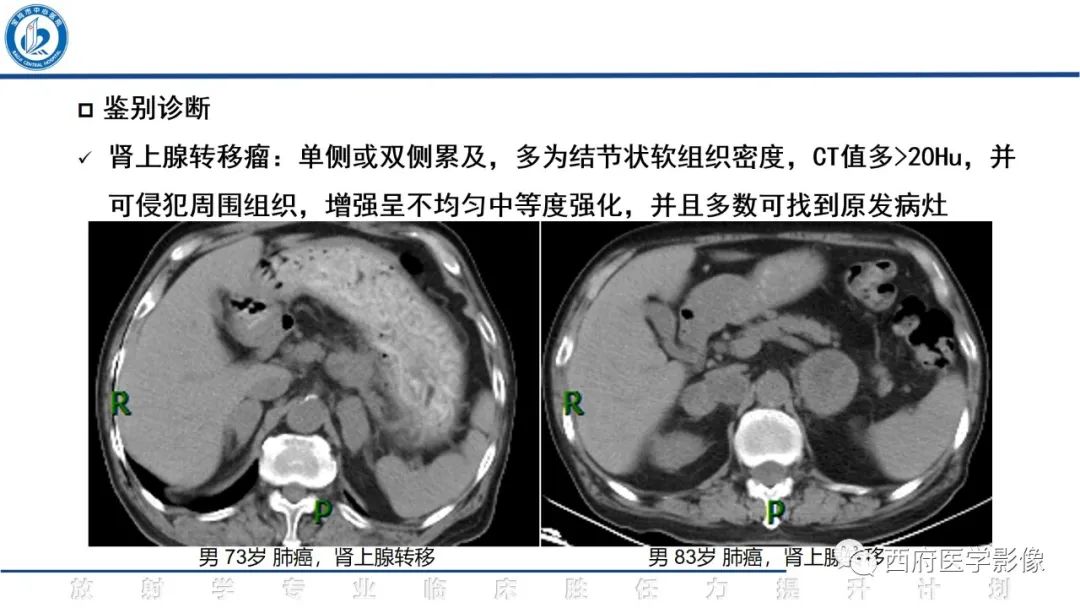 影像PPT - 【PPT】肾上腺大结节样增生影像诊断-18