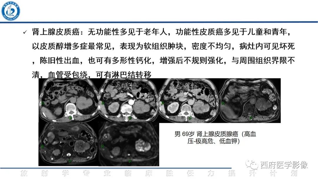 影像PPT - 【PPT】肾上腺大结节样增生影像诊断-19