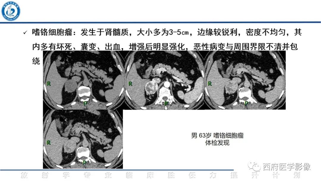 影像PPT - 【PPT】肾上腺大结节样增生影像诊断-20