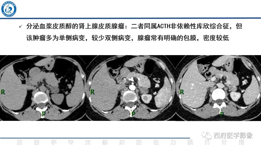 影像PPT - 【PPT】肾上腺大结节样增生影像诊断-21