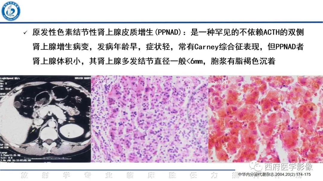 影像PPT - 【PPT】肾上腺大结节样增生影像诊断-22