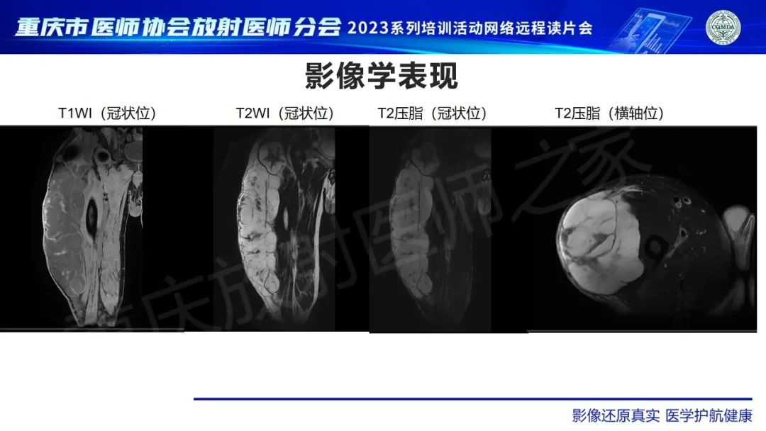 影像PPT - 【病例】大腿黏液纤维肉瘤1例MR影像-4