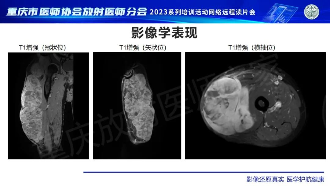 影像PPT - 【病例】大腿黏液纤维肉瘤1例MR影像-5