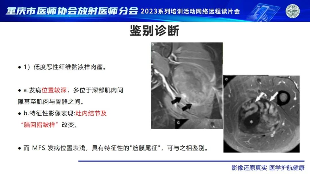影像PPT - 【病例】大腿黏液纤维肉瘤1例MR影像-15