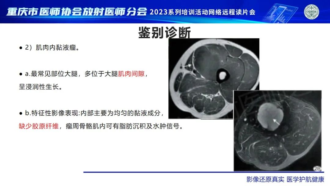 影像PPT - 【病例】大腿黏液纤维肉瘤1例MR影像-16