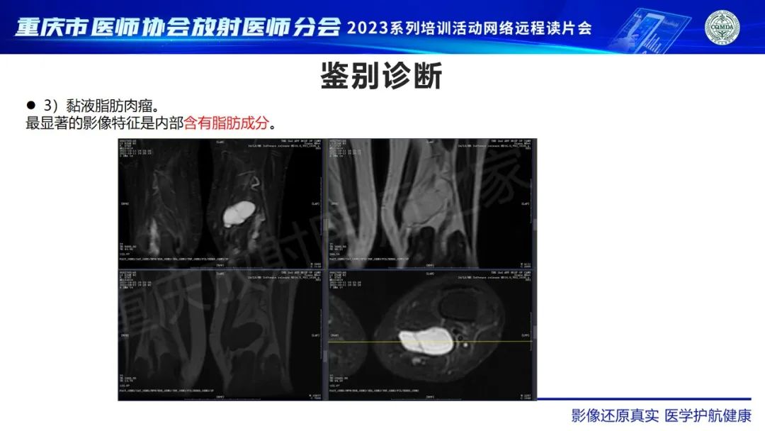 影像PPT - 【病例】大腿黏液纤维肉瘤1例MR影像-17