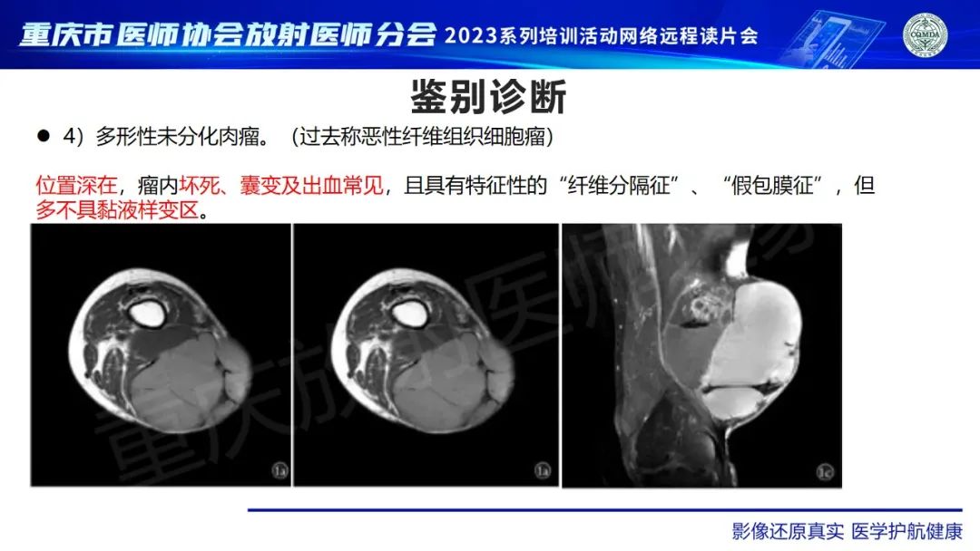 影像PPT - 【病例】大腿黏液纤维肉瘤1例MR影像-18