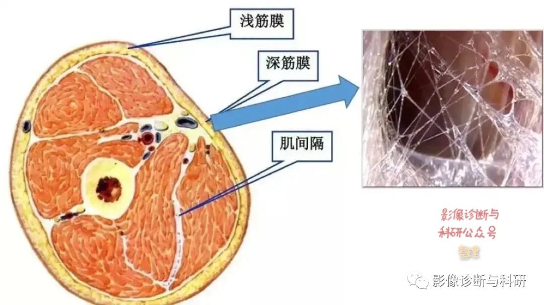 影像PPT - 腰背部皮下筋膜炎-1 影像PPT - 腰背部皮下筋膜炎-1