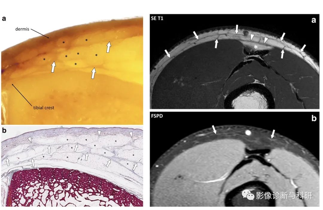 影像PPT - 腰背部皮下筋膜炎-2 影像PPT - 腰背部皮下筋膜炎-2