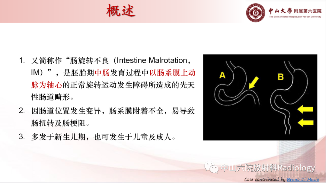 影像PPT - 【PPT】先天性肠旋转不良-2