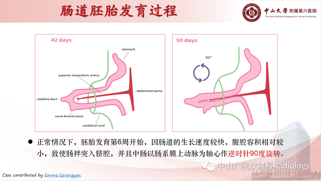 影像PPT - 【PPT】先天性肠旋转不良-5