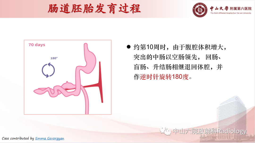 影像PPT - 【PPT】先天性肠旋转不良-6