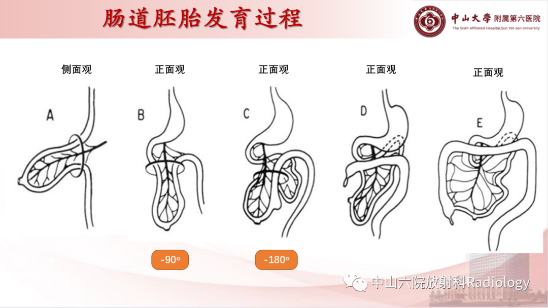 影像PPT - 【PPT】先天性肠旋转不良-8
