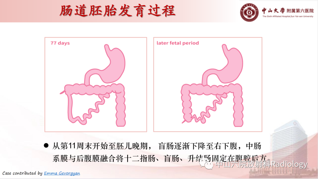 影像PPT - 【PPT】先天性肠旋转不良-7