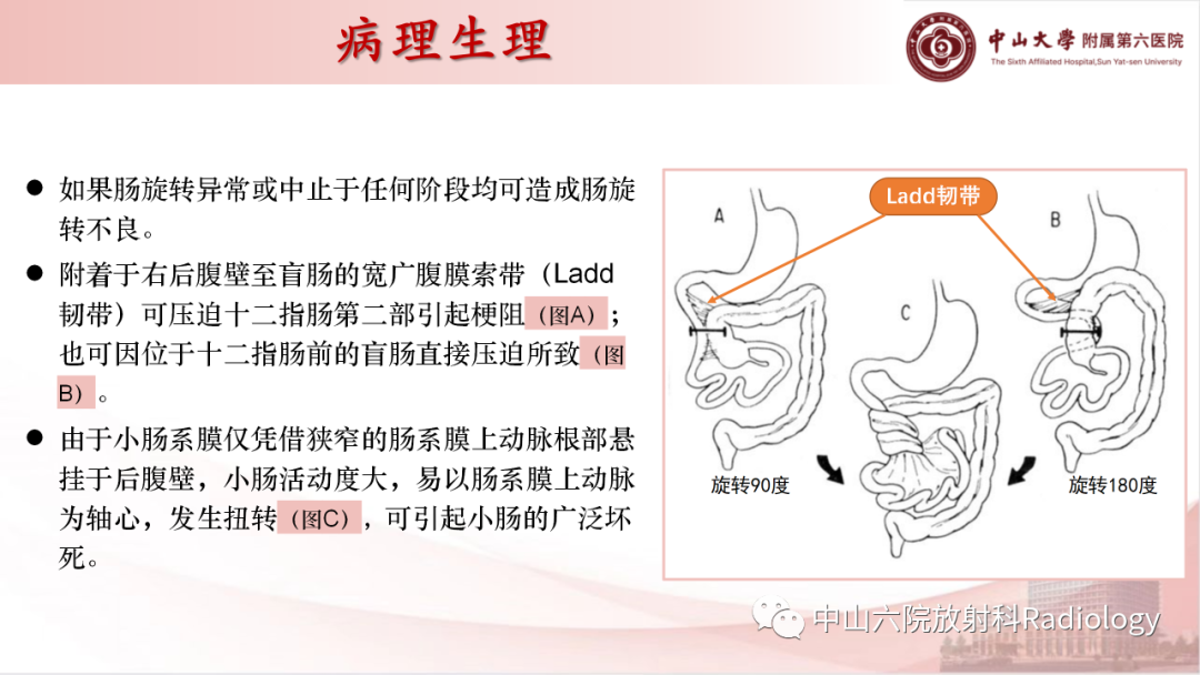 影像PPT - 【PPT】先天性肠旋转不良-9