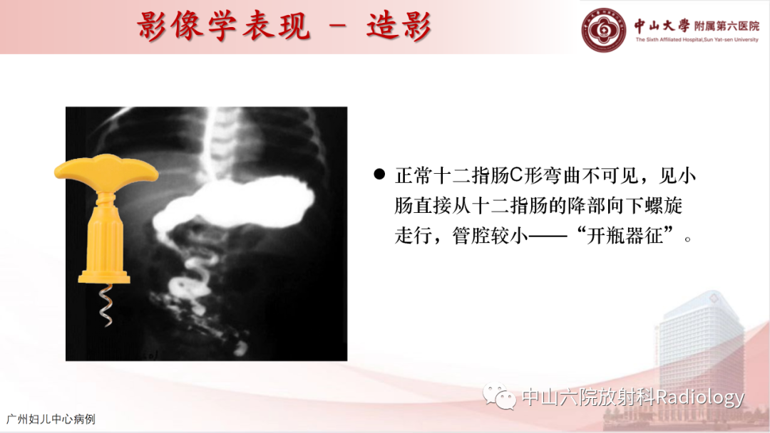 影像PPT - 【PPT】先天性肠旋转不良-12