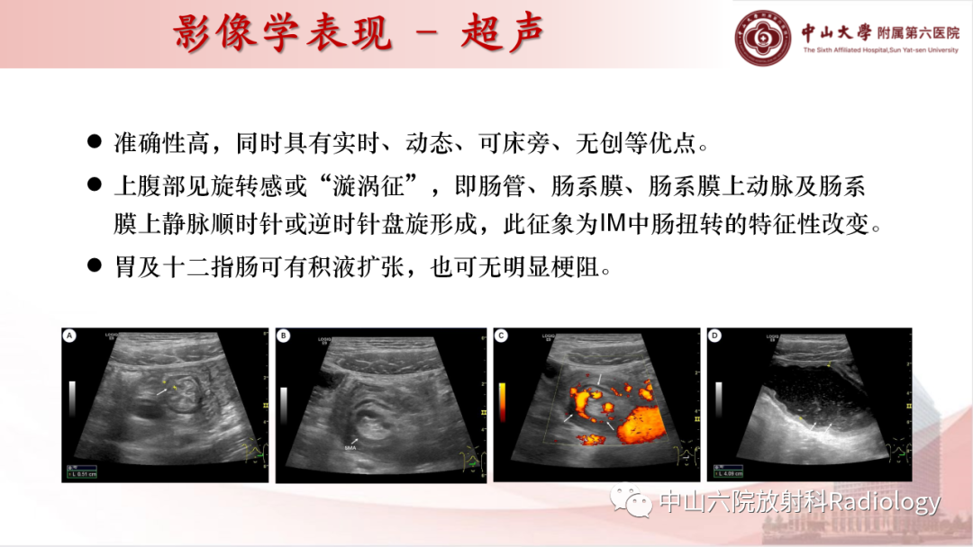 影像PPT - 【PPT】先天性肠旋转不良-13