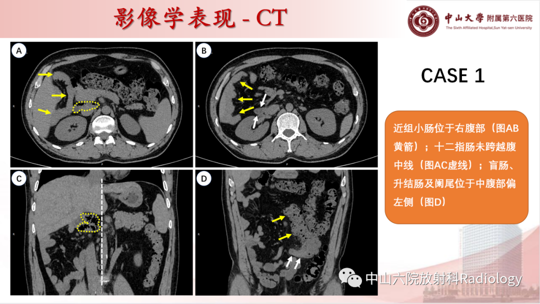 影像PPT - 【PPT】先天性肠旋转不良-15