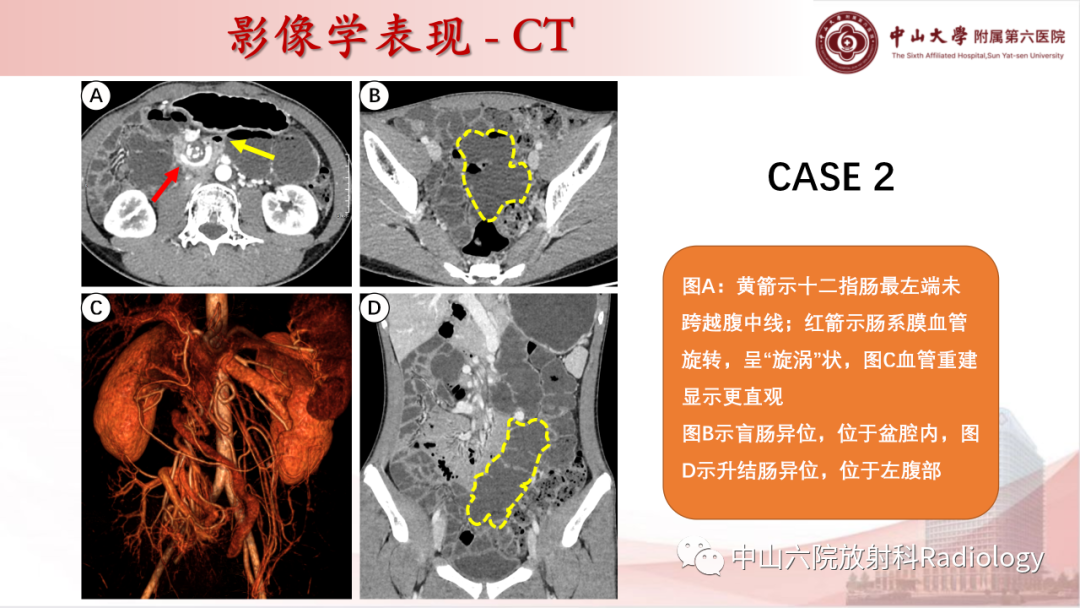影像PPT - 【PPT】先天性肠旋转不良-16