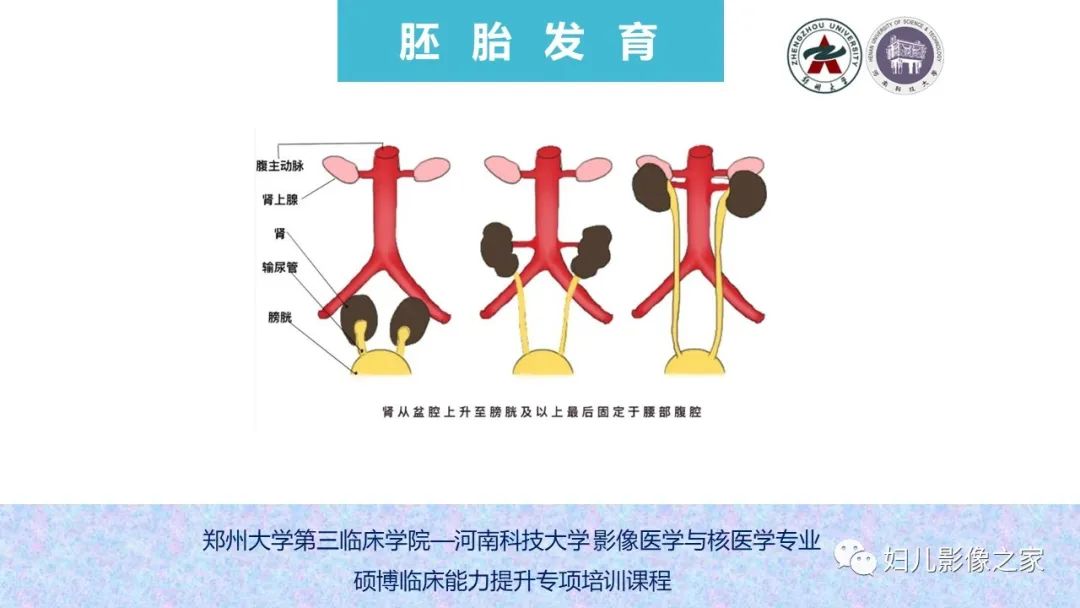 影像PPT - 【PPT】泌尿系先天性发育畸形的影像诊断-6