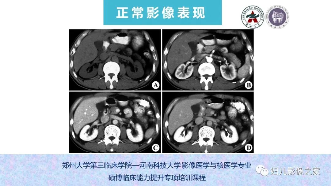 影像PPT - 【PPT】泌尿系先天性发育畸形的影像诊断-14