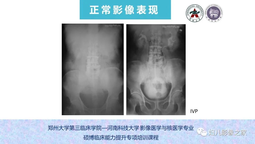 影像PPT - 【PPT】泌尿系先天性发育畸形的影像诊断-12
