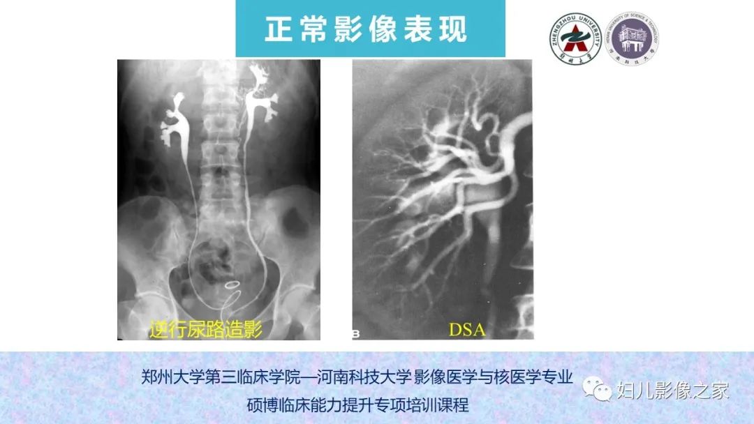 影像PPT - 【PPT】泌尿系先天性发育畸形的影像诊断-13