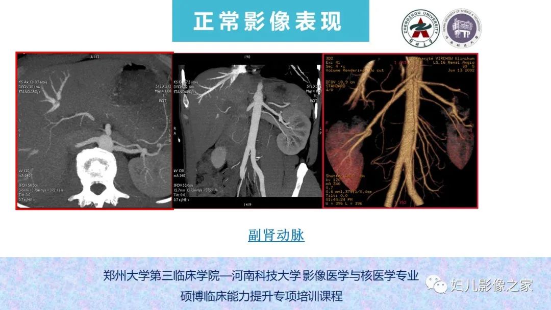 影像PPT - 【PPT】泌尿系先天性发育畸形的影像诊断-15