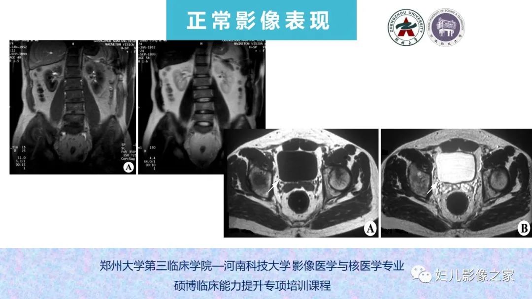 影像PPT - 【PPT】泌尿系先天性发育畸形的影像诊断-16