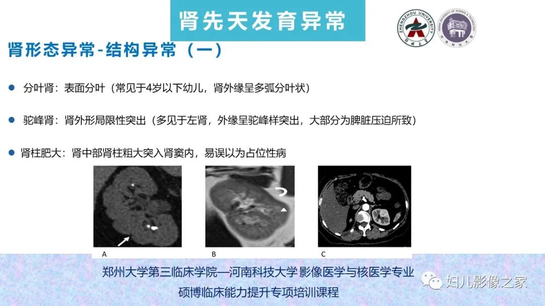影像PPT - 【PPT】泌尿系先天性发育畸形的影像诊断-21