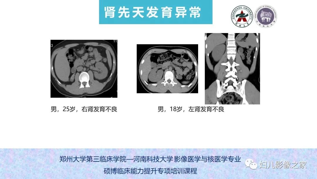 影像PPT - 【PPT】泌尿系先天性发育畸形的影像诊断-23