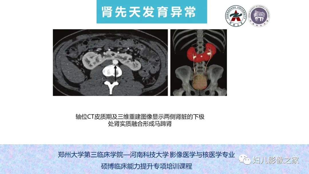 影像PPT - 【PPT】泌尿系先天性发育畸形的影像诊断-25