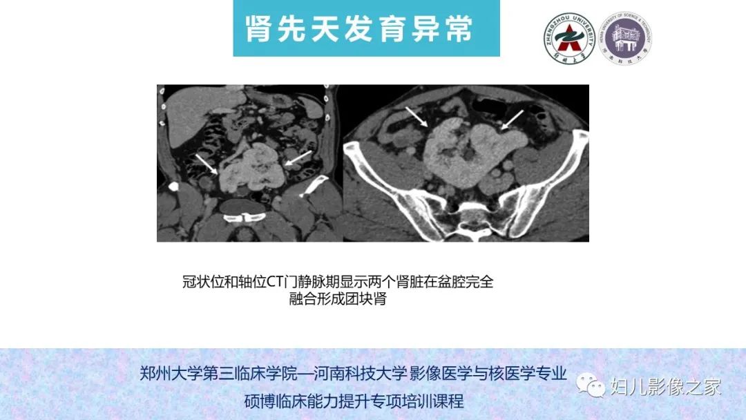 影像PPT - 【PPT】泌尿系先天性发育畸形的影像诊断-26