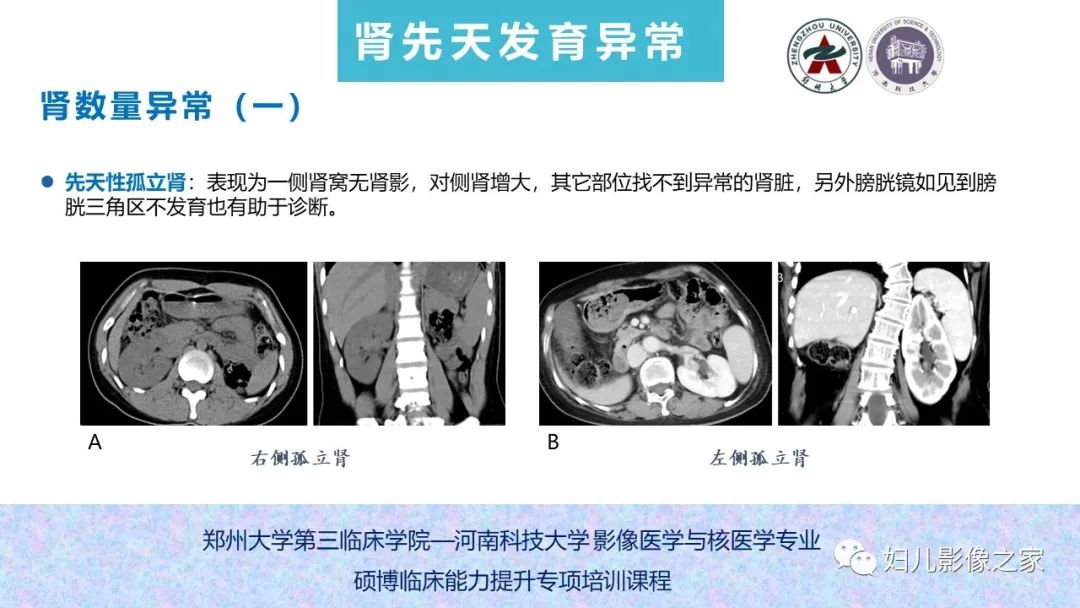 影像PPT - 【PPT】泌尿系先天性发育畸形的影像诊断-27