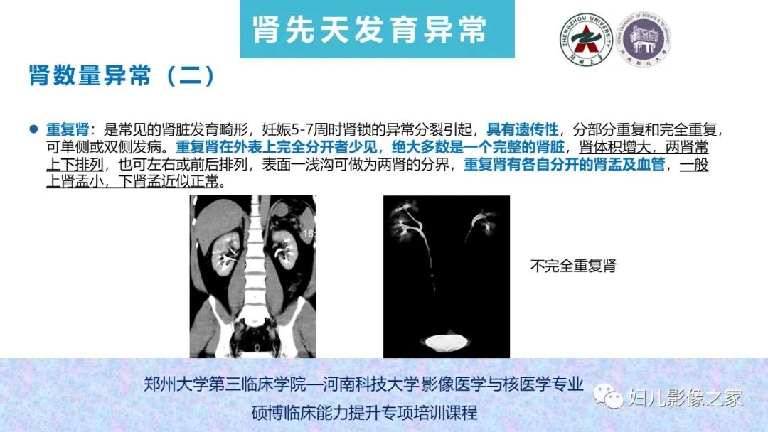 影像PPT - 【PPT】泌尿系先天性发育畸形的影像诊断-28