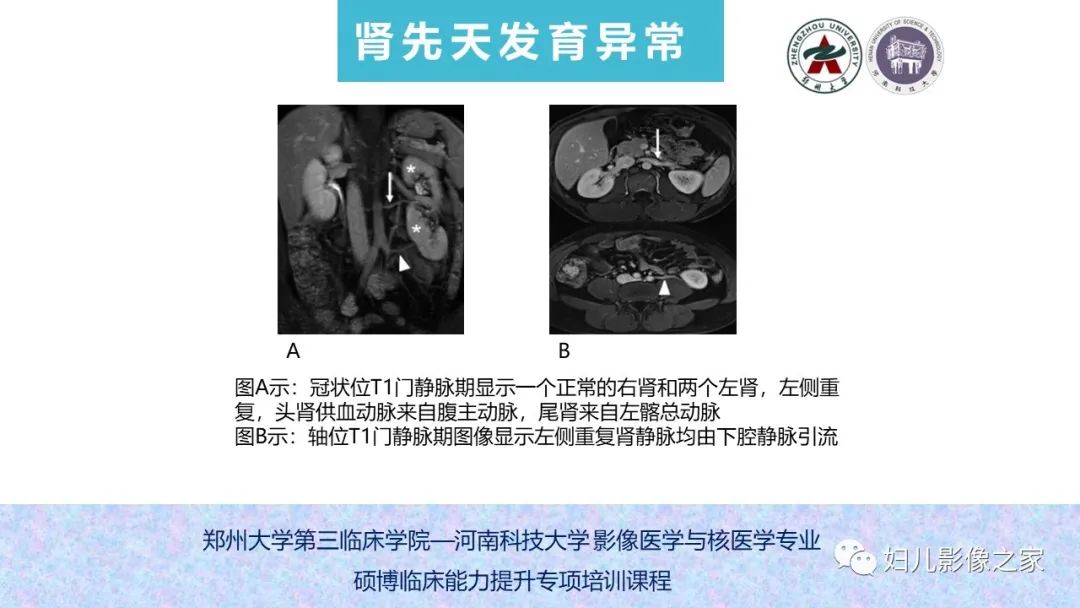 影像PPT - 【PPT】泌尿系先天性发育畸形的影像诊断-29