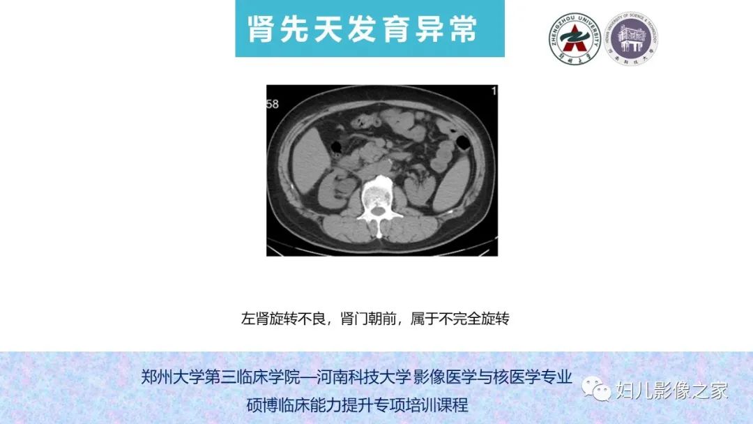 影像PPT - 【PPT】泌尿系先天性发育畸形的影像诊断-31