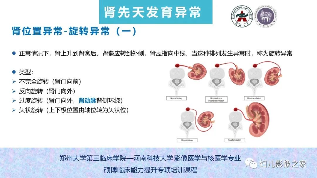 影像PPT - 【PPT】泌尿系先天性发育畸形的影像诊断-30