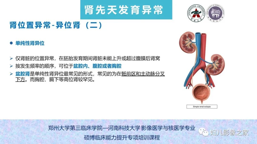 影像PPT - 【PPT】泌尿系先天性发育畸形的影像诊断-33