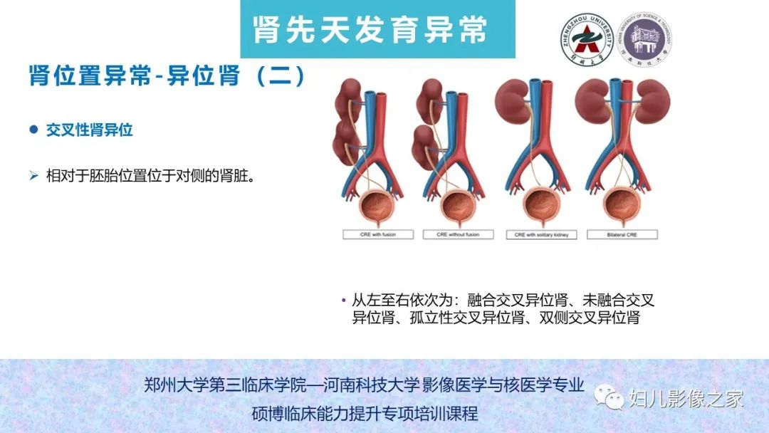 影像PPT - 【PPT】泌尿系先天性发育畸形的影像诊断-34