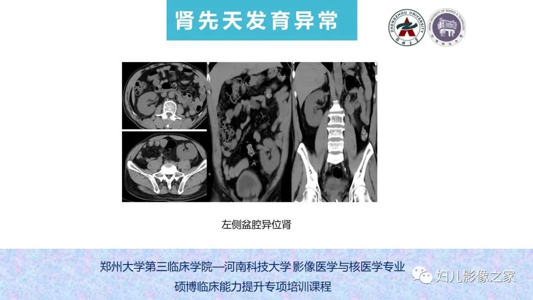影像PPT - 【PPT】泌尿系先天性发育畸形的影像诊断-35