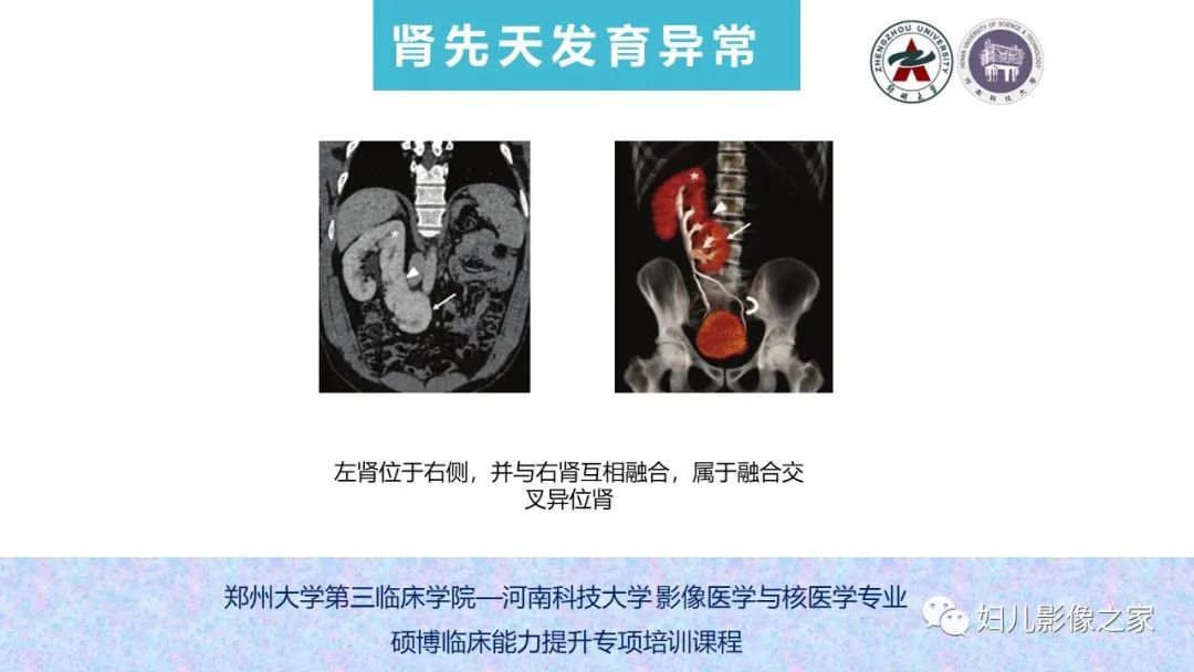 影像PPT - 【PPT】泌尿系先天性发育畸形的影像诊断-36