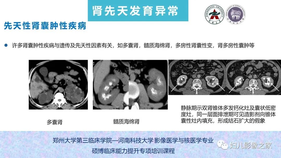 影像PPT - 【PPT】泌尿系先天性发育畸形的影像诊断-39
