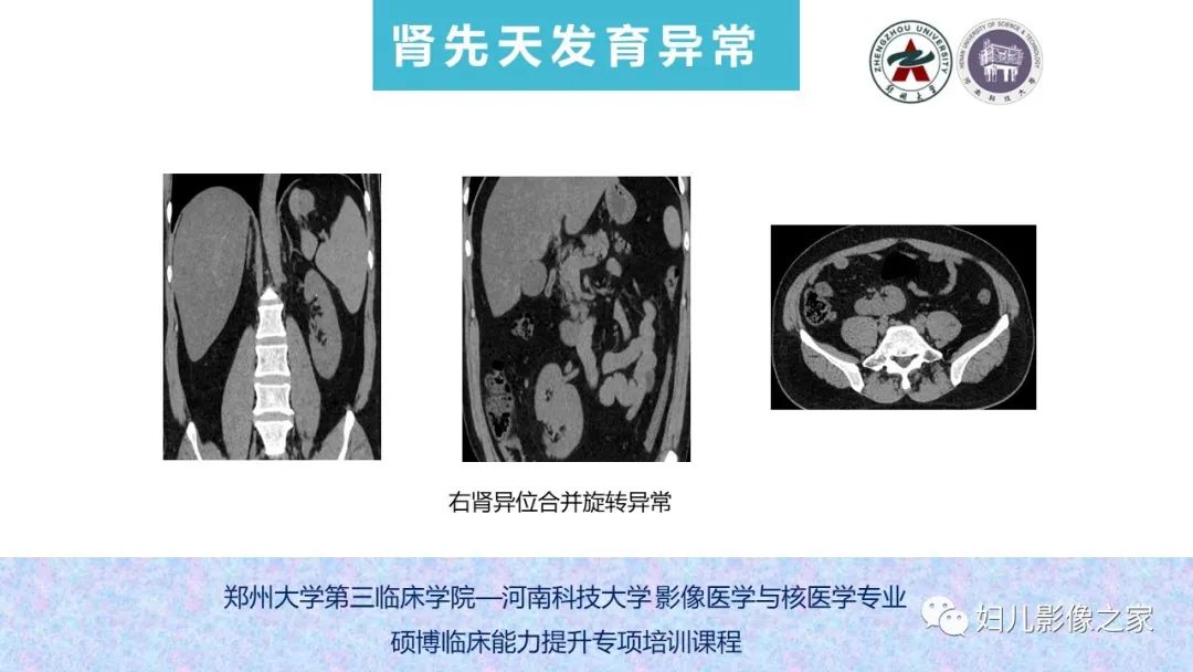 影像PPT - 【PPT】泌尿系先天性发育畸形的影像诊断-37