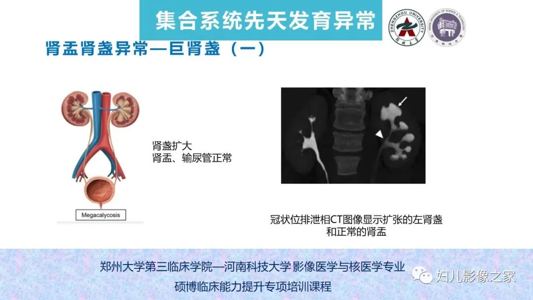 影像PPT - 【PPT】泌尿系先天性发育畸形的影像诊断-41
