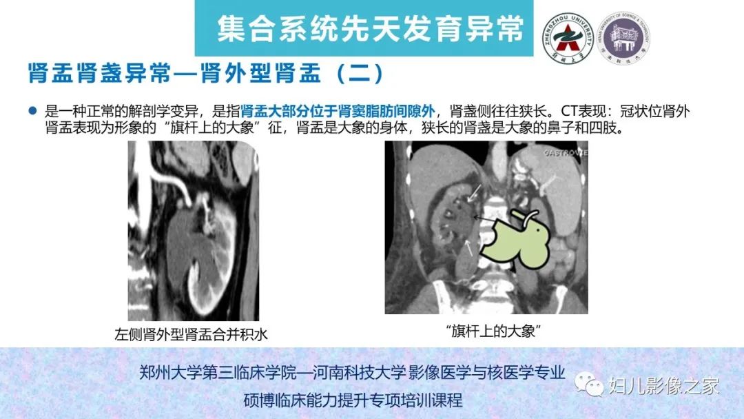 影像PPT - 【PPT】泌尿系先天性发育畸形的影像诊断-42