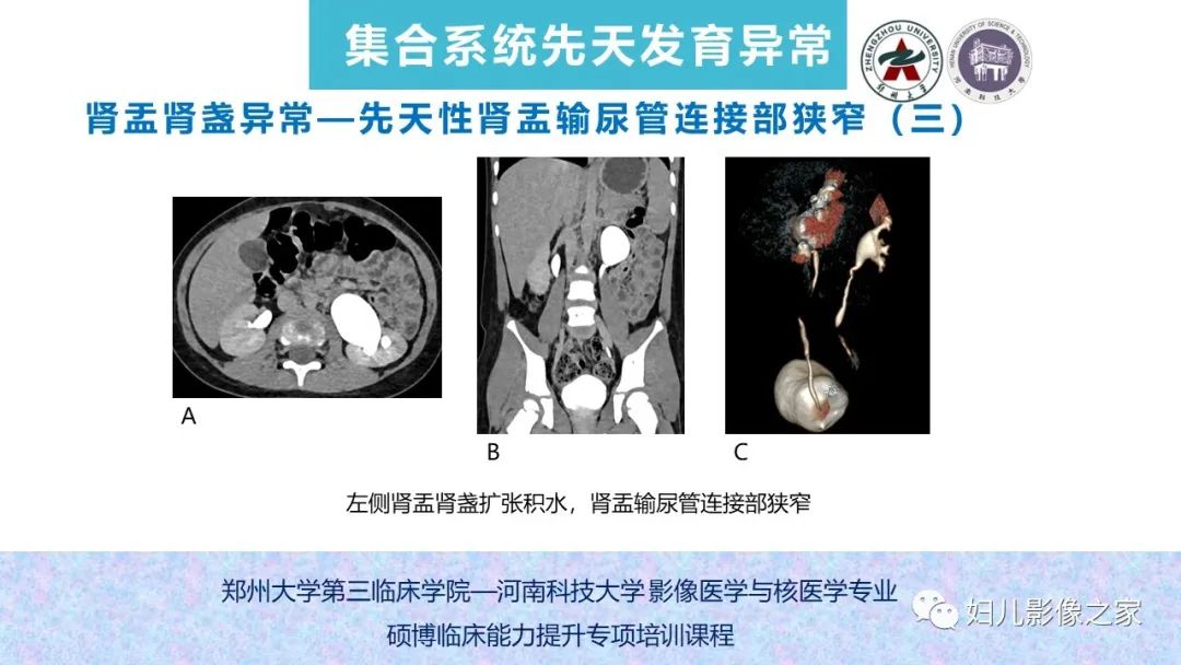 影像PPT - 【PPT】泌尿系先天性发育畸形的影像诊断-45