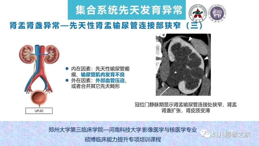 影像PPT - 【PPT】泌尿系先天性发育畸形的影像诊断-44