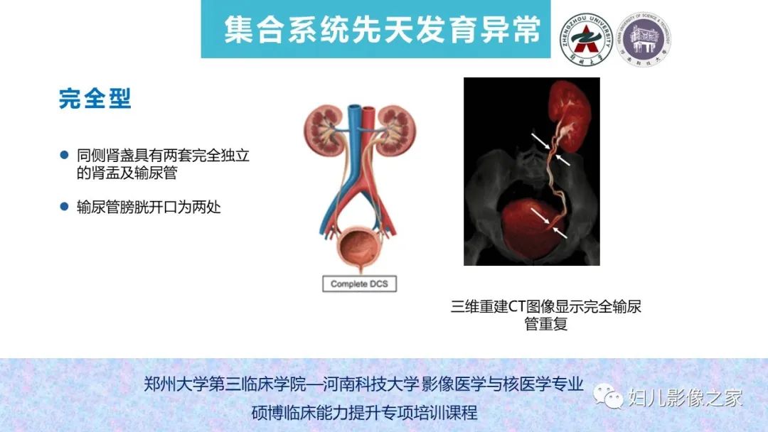 影像PPT - 【PPT】泌尿系先天性发育畸形的影像诊断-47