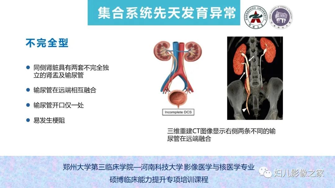 影像PPT - 【PPT】泌尿系先天性发育畸形的影像诊断-48